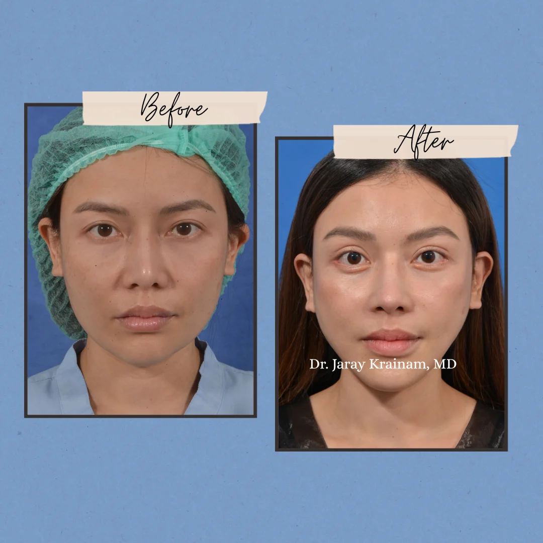 102-2 - Dr. Jaray Cosmetic Surgery
