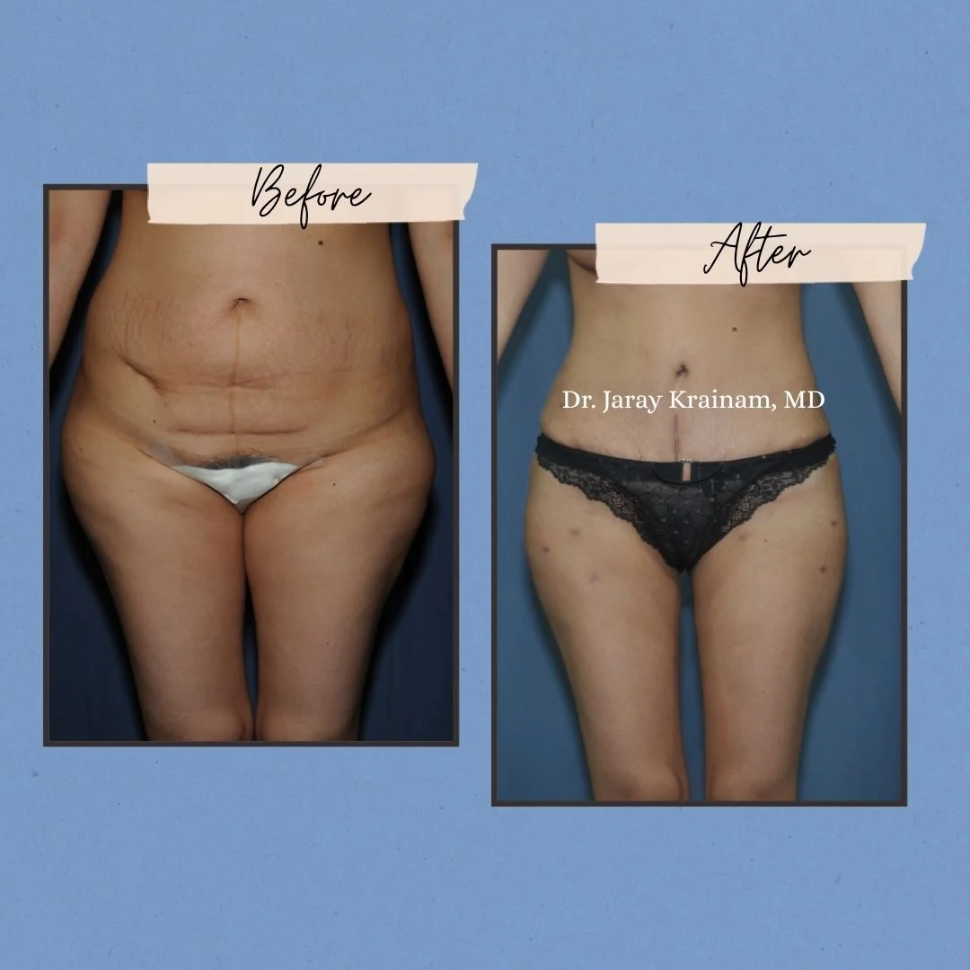 54 1 - Dr. Jaray Cosmetic Surgery