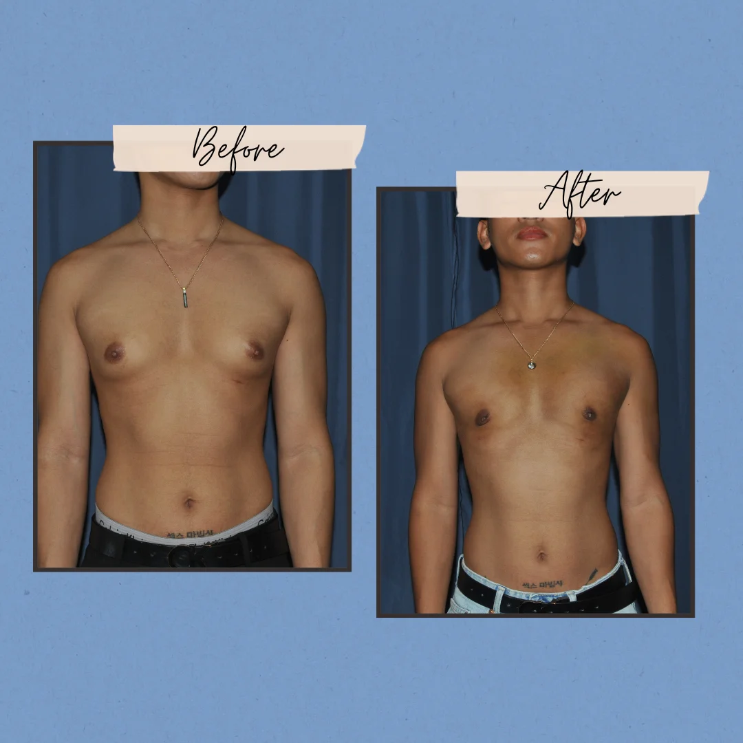 Neutral-Rustic-Before-After-Photos-Instagram-Post-40-2 1 - Dr. Jaray Cosmetic Surgery