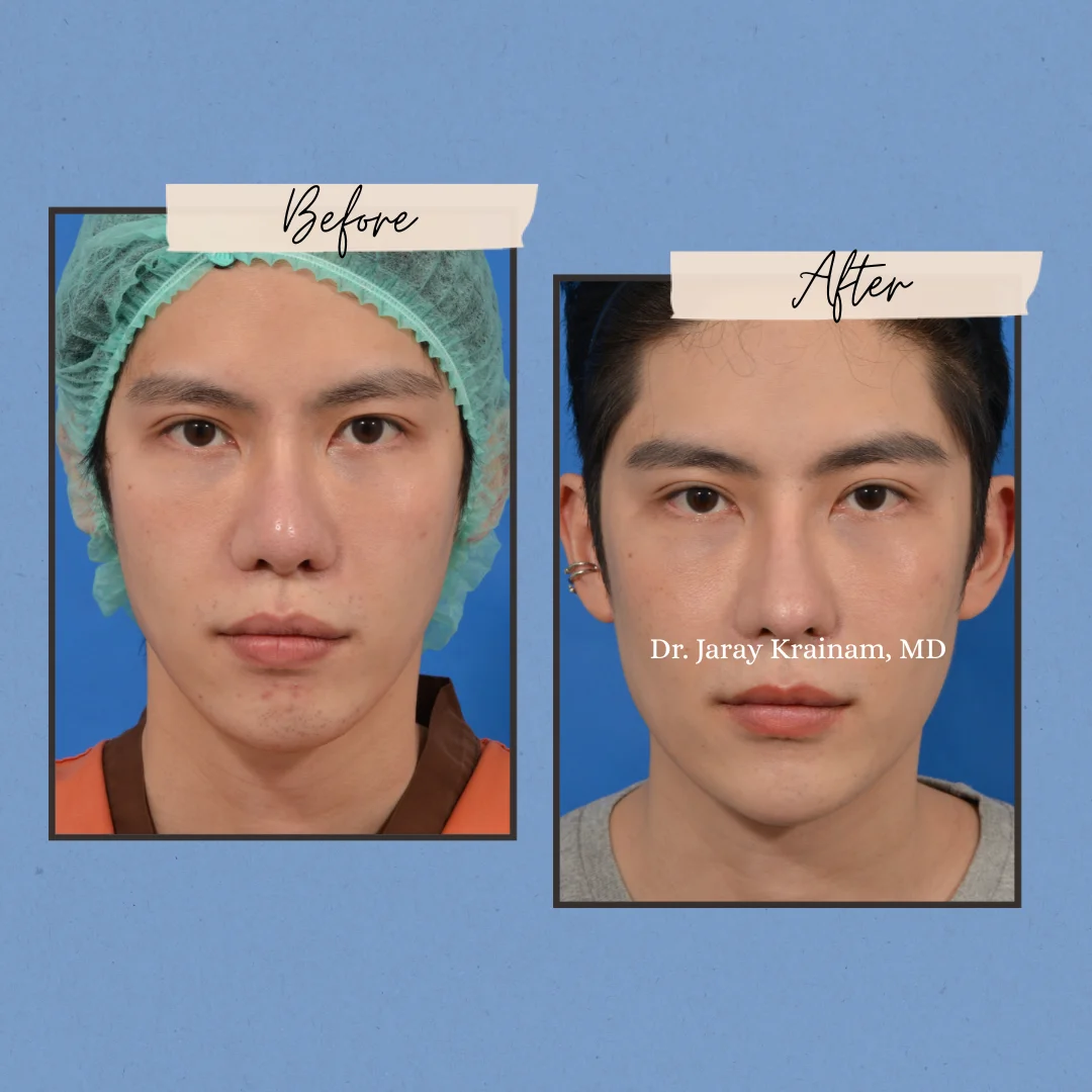 158-3 - Dr. Jaray Cosmetic Surgery