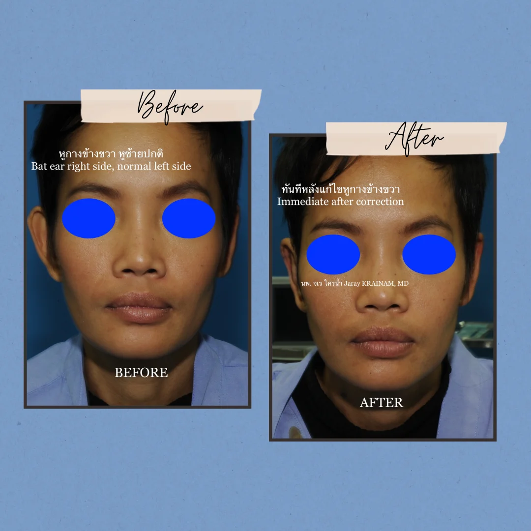 170-2 - Dr. Jaray Cosmetic Surgery