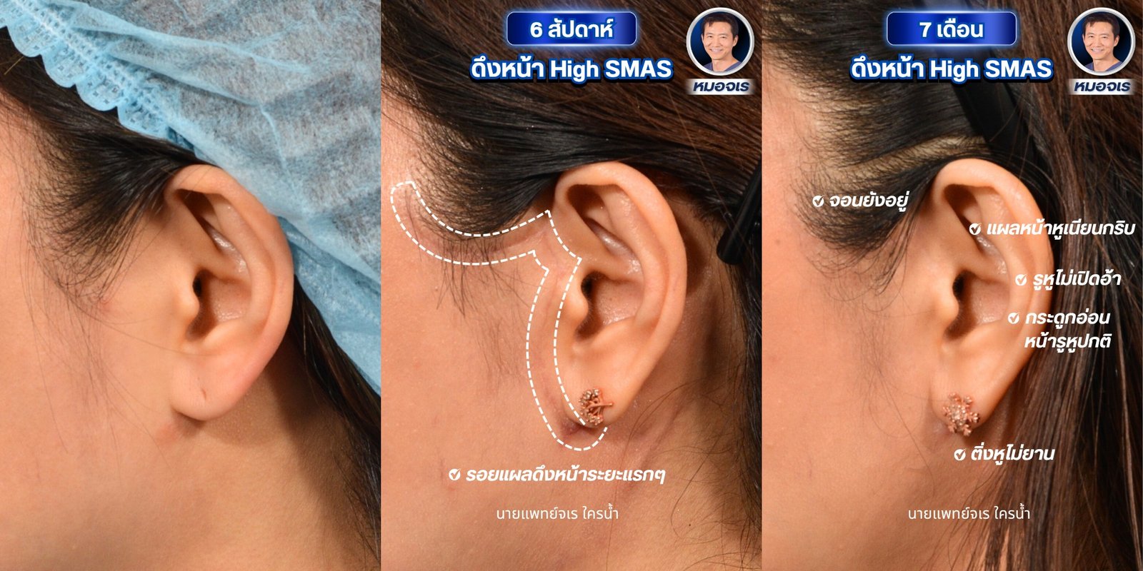 508185979_1134610425359764_1002536395463371785_n - Dr. Jaray Cosmetic Surgery