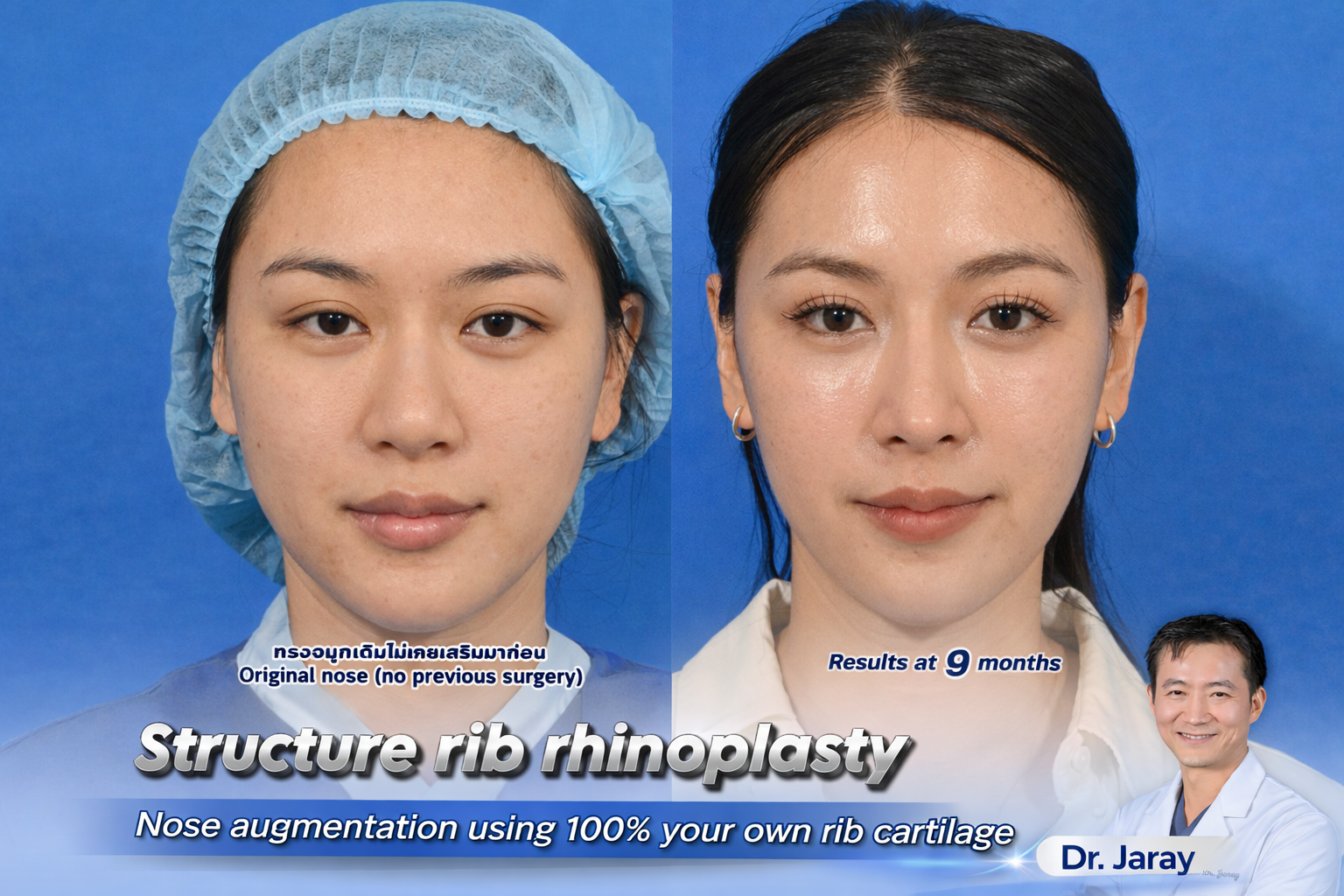 Before (left) and after (right) photos of a woman undergoing rib cartilage nose augmentation—9 months post-op; Dr. Jaray advertisement.