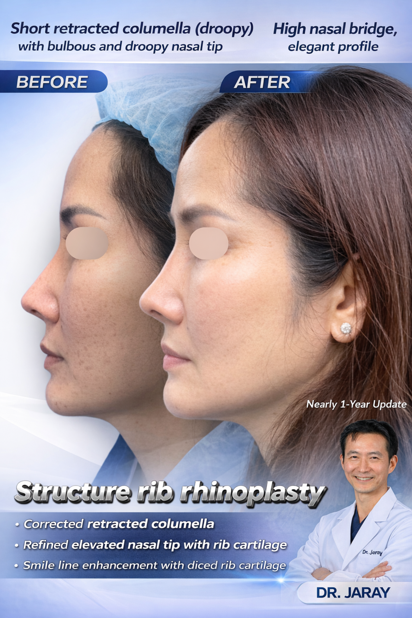 Side-by-side profile of a woman showing a before and after rhinoplasty result with a refined nasal tip.